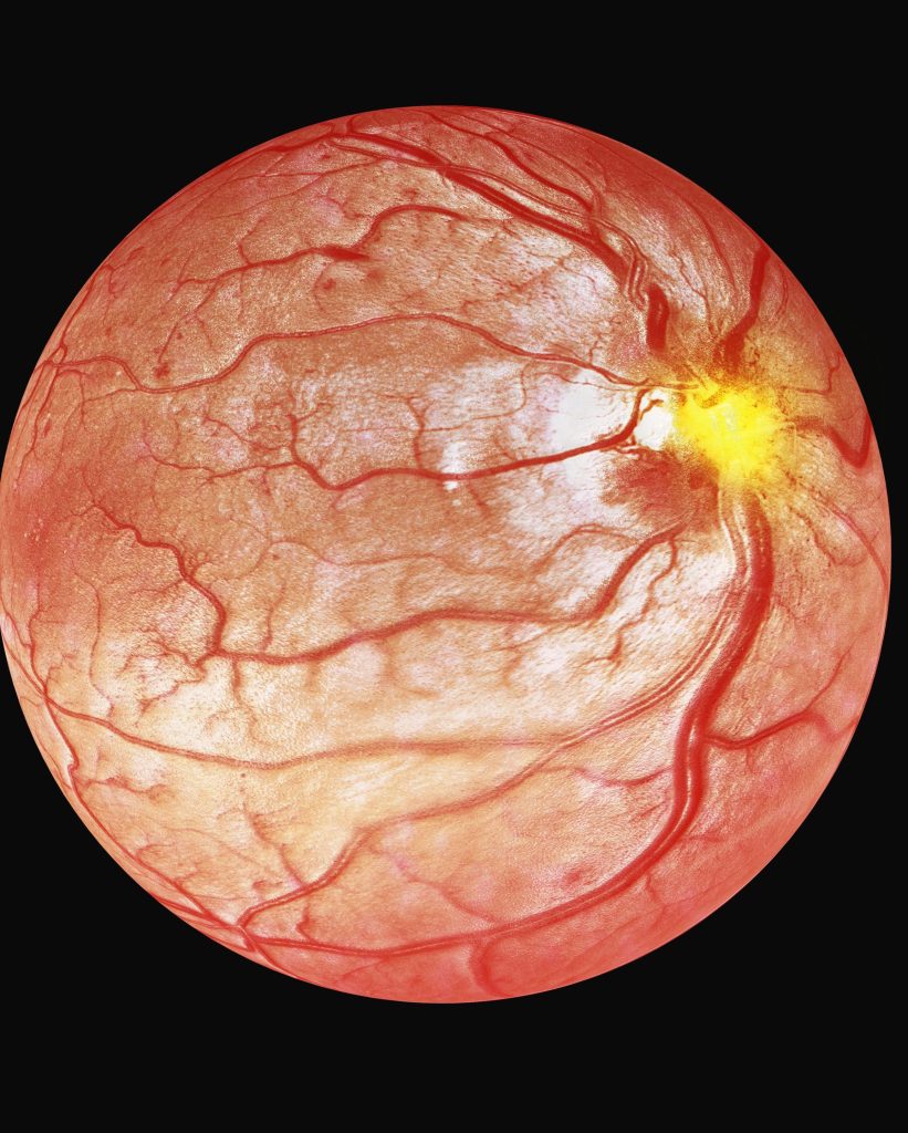 retinopatie diabetica